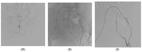 Transcatheter Arterial Embolization (TAE) in the Management of 